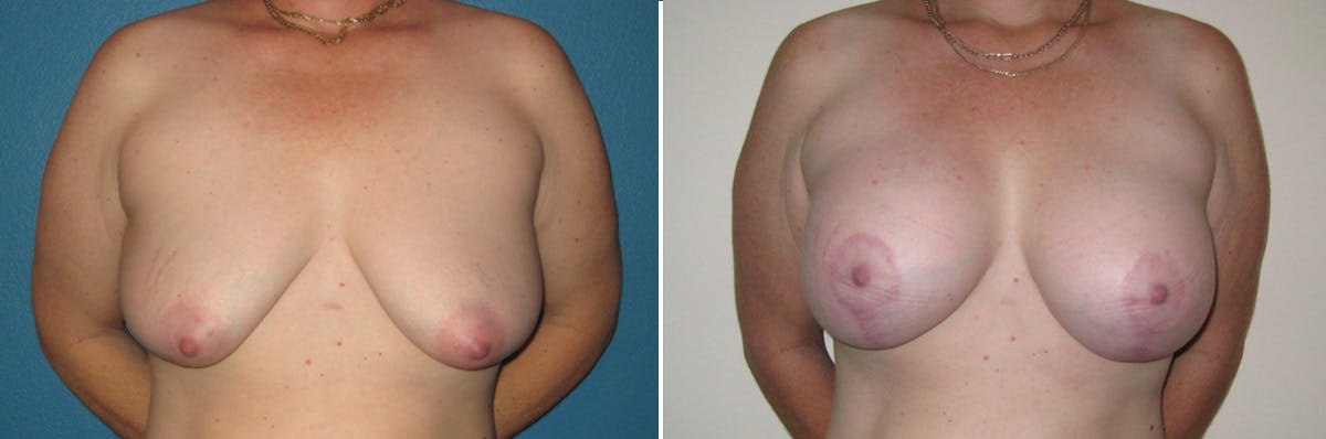 Breast Lift Before & After Gallery - Patient 199029 - Image 1