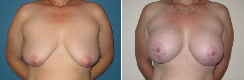 Breast Lift Before & After Gallery - Patient 199029 - Image 1