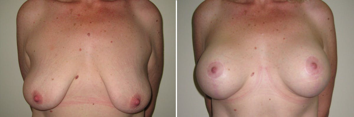 Breast Lift Before & After Gallery - Patient 154580 - Image 1