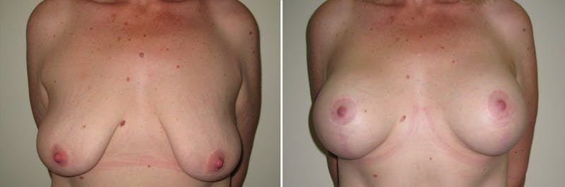 Breast Lift Before & After Gallery - Patient 154580 - Image 1