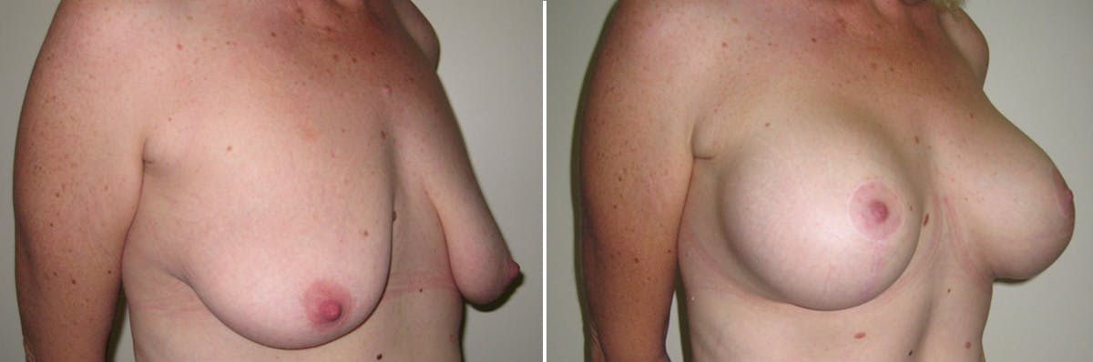 Breast Lift Before & After Gallery - Patient 154580 - Image 2
