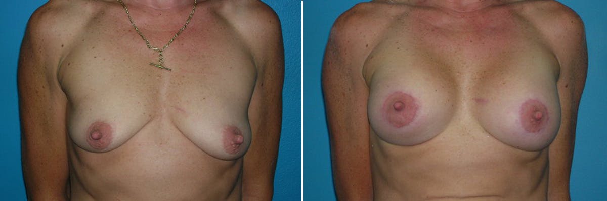 Breast Lift Before & After Gallery - Patient 348139 - Image 1