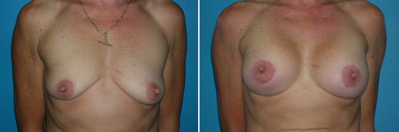 Breast Lift Before & After Gallery - Patient 348139 - Image 1