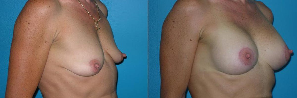 Breast Lift Before & After Gallery - Patient 348139 - Image 2