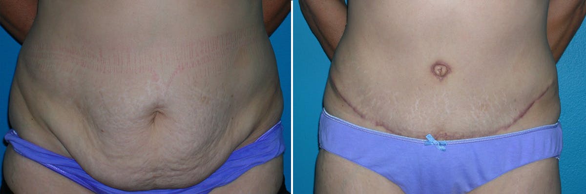 Tummy Tuck Before & After Gallery - Patient 181670 - Image 1