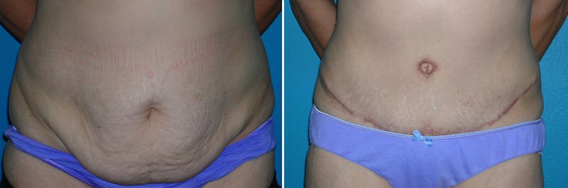 Tummy Tuck Before & After Gallery - Patient 181670 - Image 1