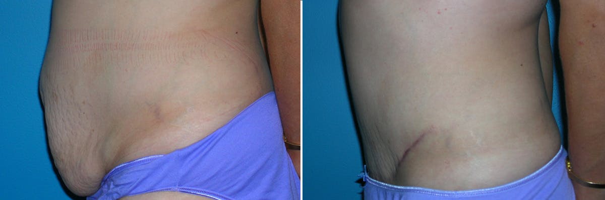 Tummy Tuck Before & After Gallery - Patient 181670 - Image 2