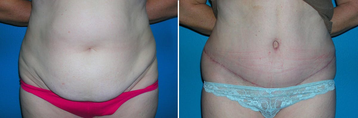 Tummy Tuck Before & After Gallery - Patient 373562 - Image 1