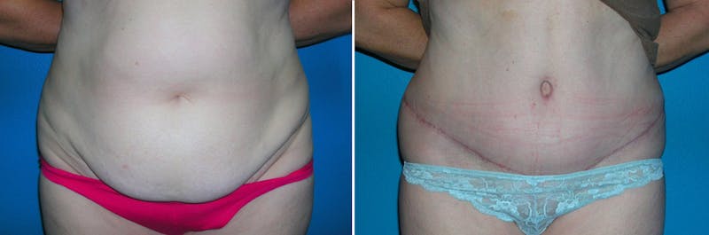 Tummy Tuck Before & After Gallery - Patient 373562 - Image 1