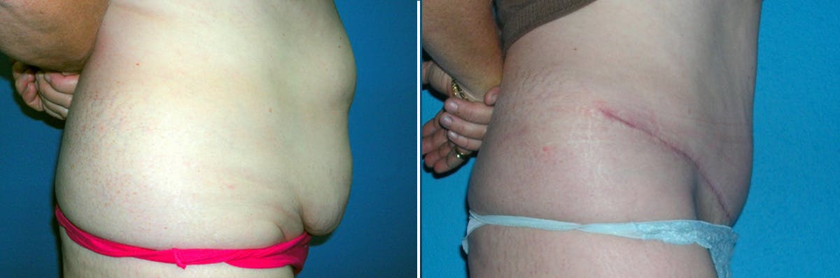 Tummy Tuck Before & After Gallery - Patient 373562 - Image 2