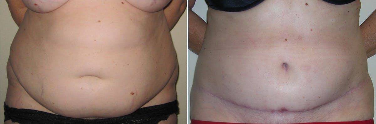 Tummy Tuck Before & After Gallery - Patient 266795 - Image 1