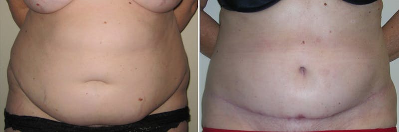 Tummy Tuck Before & After Gallery - Patient 266795 - Image 1