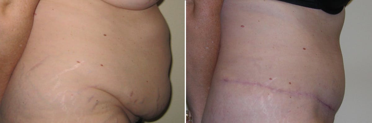 Tummy Tuck Before & After Gallery - Patient 266795 - Image 2