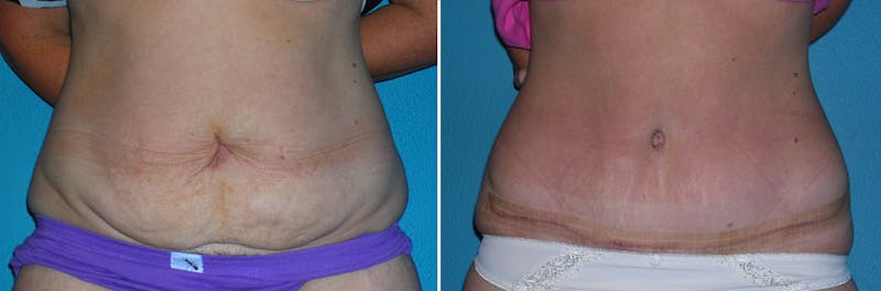 Tummy Tuck Before & After Gallery - Patient 113534 - Image 1