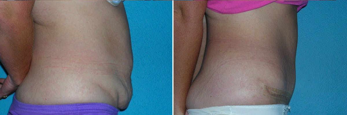 Tummy Tuck Before & After Gallery - Patient 113534 - Image 2