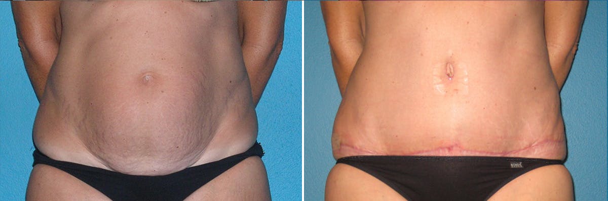 Tummy Tuck Before & After Gallery - Patient 353227 - Image 1