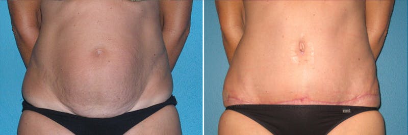 Tummy Tuck Before & After Gallery - Patient 353227 - Image 1