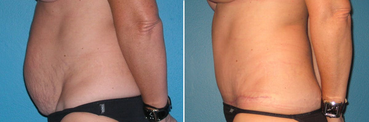Tummy Tuck Before & After Gallery - Patient 353227 - Image 2