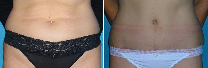 Tummy Tuck Before & After Gallery - Patient 540898 - Image 1