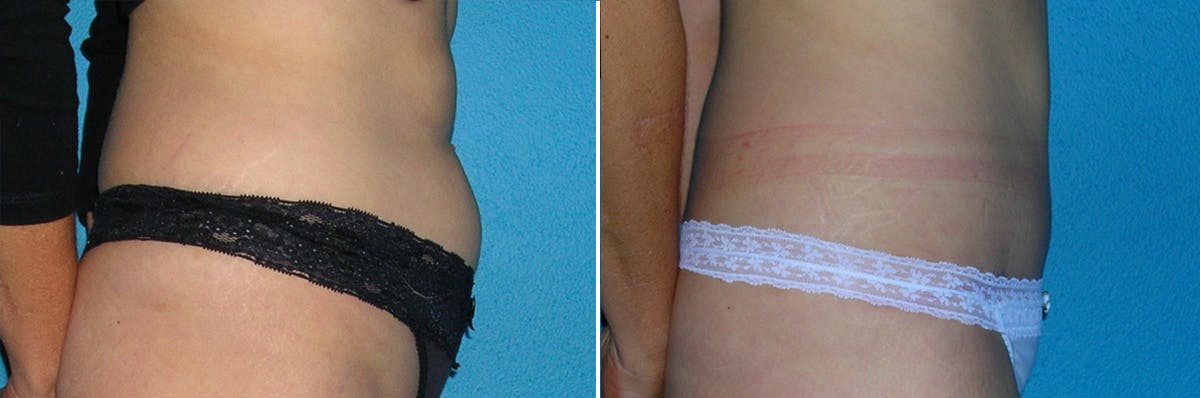 Tummy Tuck Before & After Gallery - Patient 540898 - Image 2