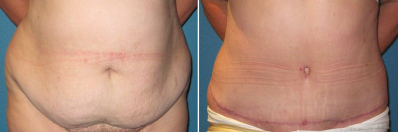 Tummy Tuck Before & After Gallery - Patient 362699 - Image 1