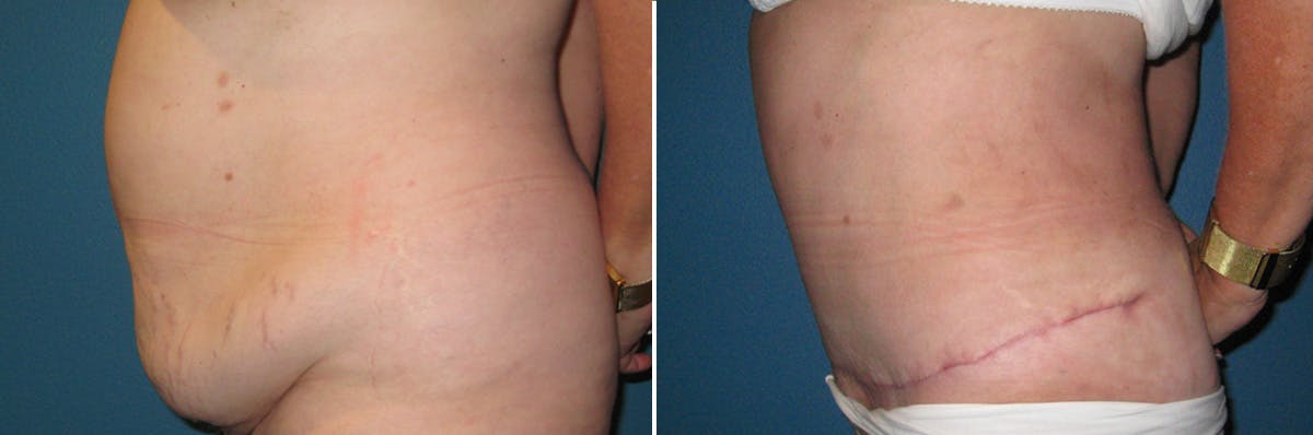 Tummy Tuck Before & After Gallery - Patient 362699 - Image 2