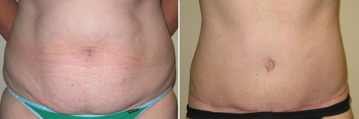 Tummy Tuck Before & After Gallery - Patient 239020 - Image 1