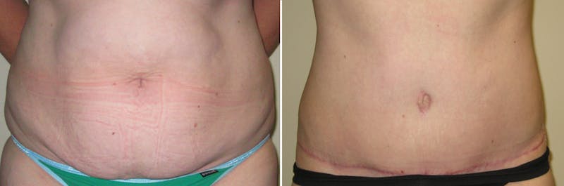 Tummy Tuck Before & After Gallery - Patient 239020 - Image 1