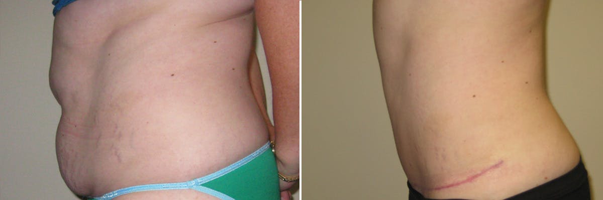 Tummy Tuck Before & After Gallery - Patient 239020 - Image 2