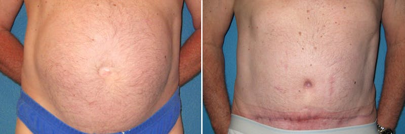 Tummy Tuck Before & After Gallery - Patient 138001 - Image 1