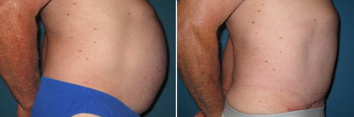 Tummy Tuck Before & After Gallery - Patient 138001 - Image 2