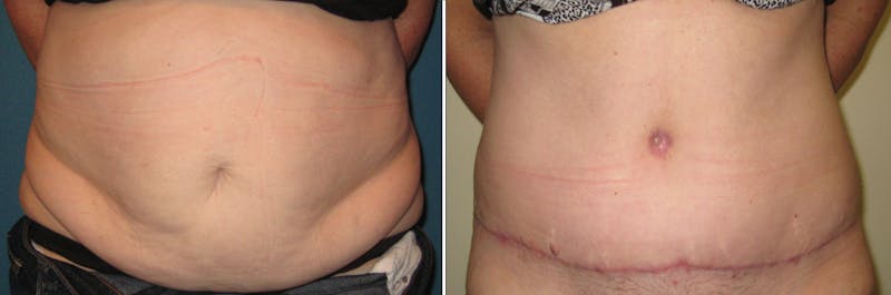 Tummy Tuck Before & After Gallery - Patient 412162 - Image 1