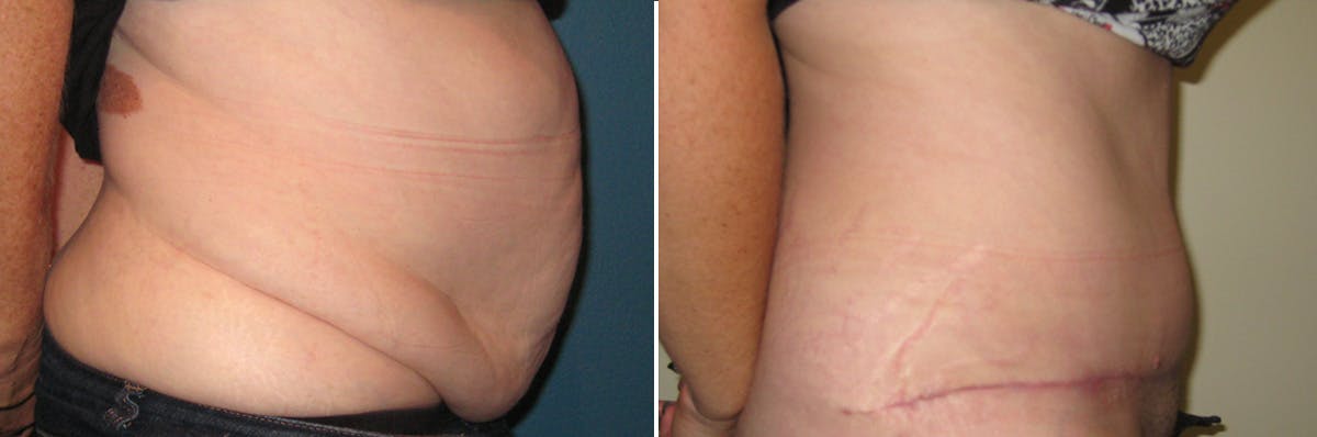 Tummy Tuck Before & After Gallery - Patient 412162 - Image 2