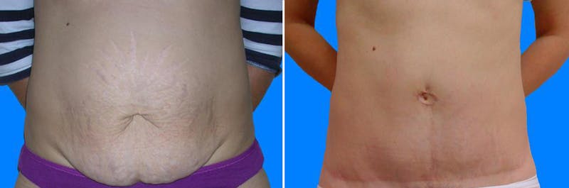 Tummy Tuck Before & After Gallery - Patient 131155 - Image 1