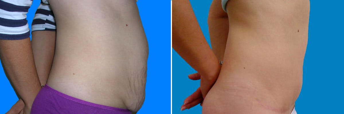 Tummy Tuck Before & After Gallery - Patient 131155 - Image 2