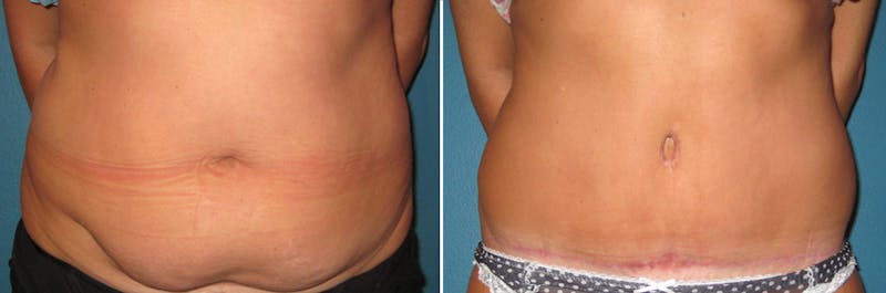 Tummy Tuck Before & After Gallery - Patient 809108 - Image 1