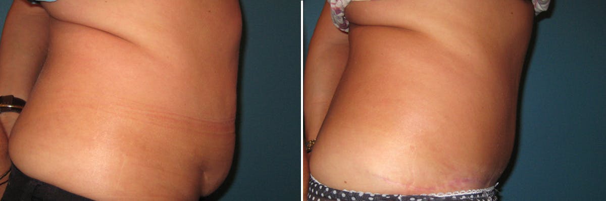 Tummy Tuck Before & After Gallery - Patient 809108 - Image 2