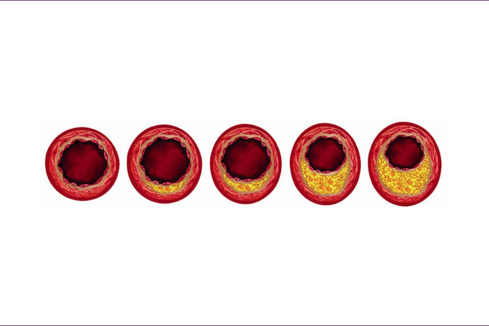 *Illustration of the buildup of plaque in arteries.* By AstraZeneca. atherosclerosis