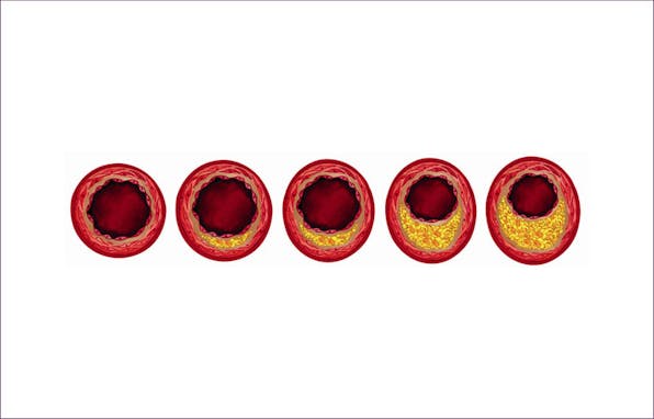 atherosclerosis