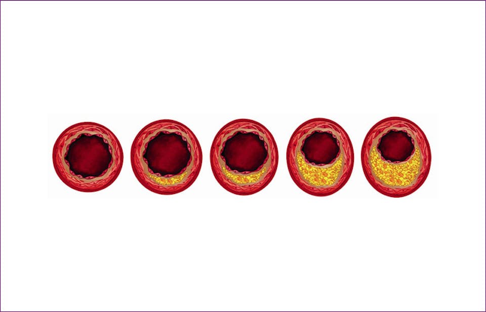 atherosclerosis