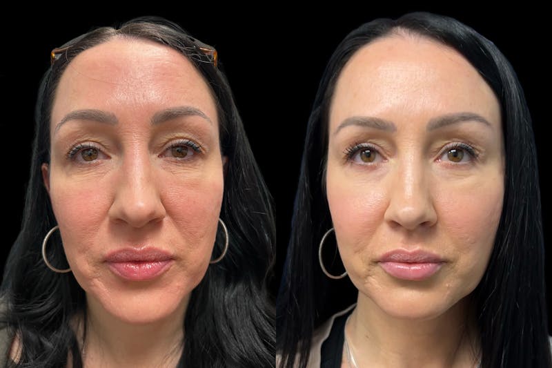 Facial Fat Transfer Before & After Gallery - Patient 389213 - Image 1