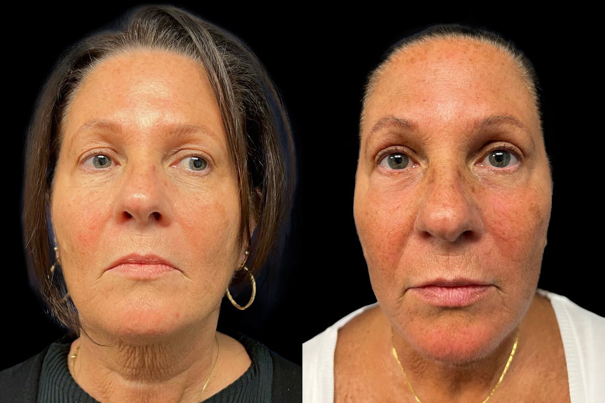Upper Blepharoplasty Before & After Gallery - Patient 328228 - Image 1