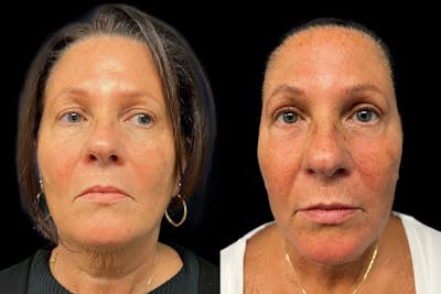 Upper Blepharoplasty Before & After Gallery - Patient 328228 - Image 1