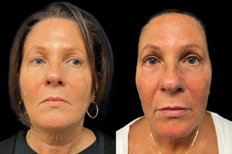 CO2 Laser Skin Resurfacing Before & After Gallery - Patient 136163 - Image 1