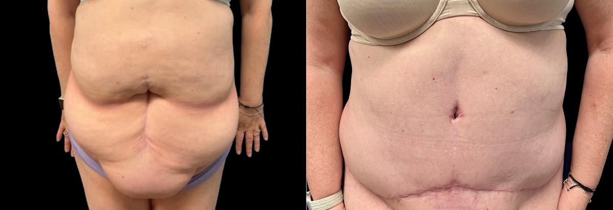 Abdominoplasty Before & After Gallery - Patient 116264 - Image 1