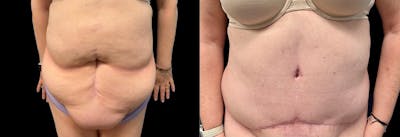 Abdominoplasty Before & After Gallery - Patient 116264 - Image 1