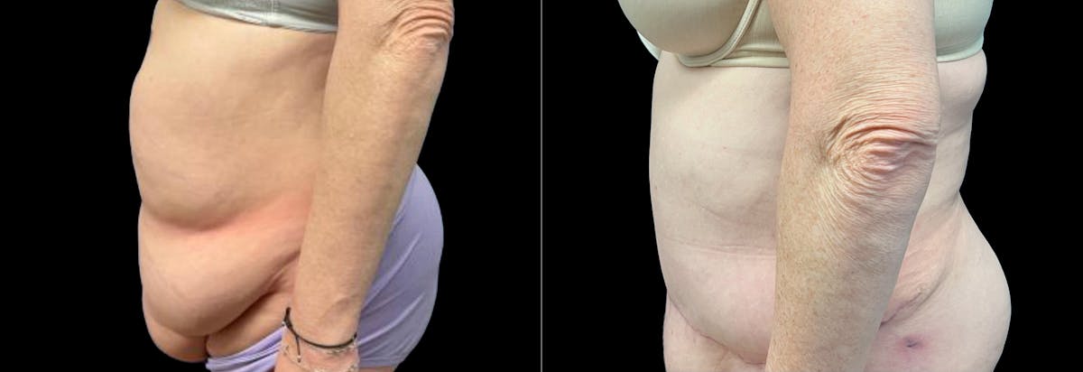 Abdominoplasty Before & After Gallery - Patient 116264 - Image 2