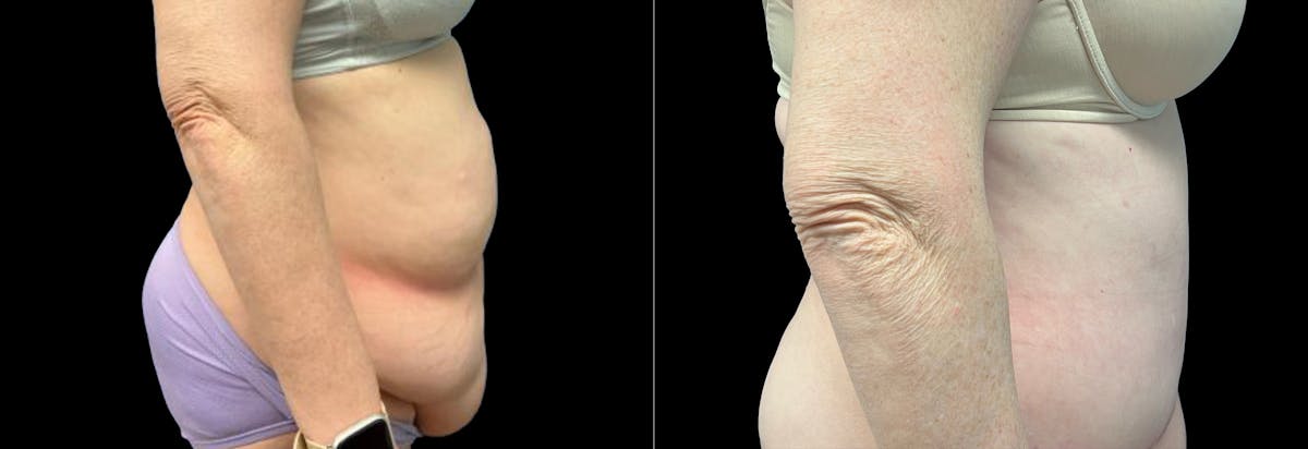 Abdominoplasty Before & After Gallery - Patient 116264 - Image 3
