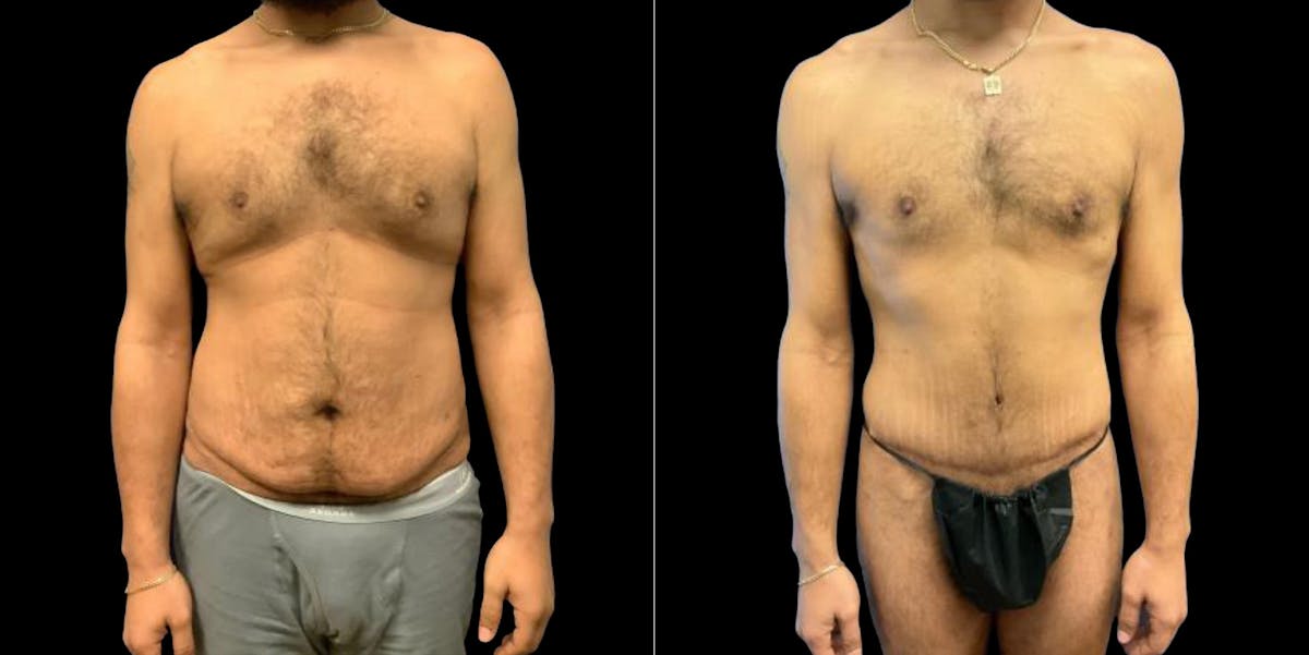Abdominoplasty Before & After Gallery - Patient 809044 - Image 1