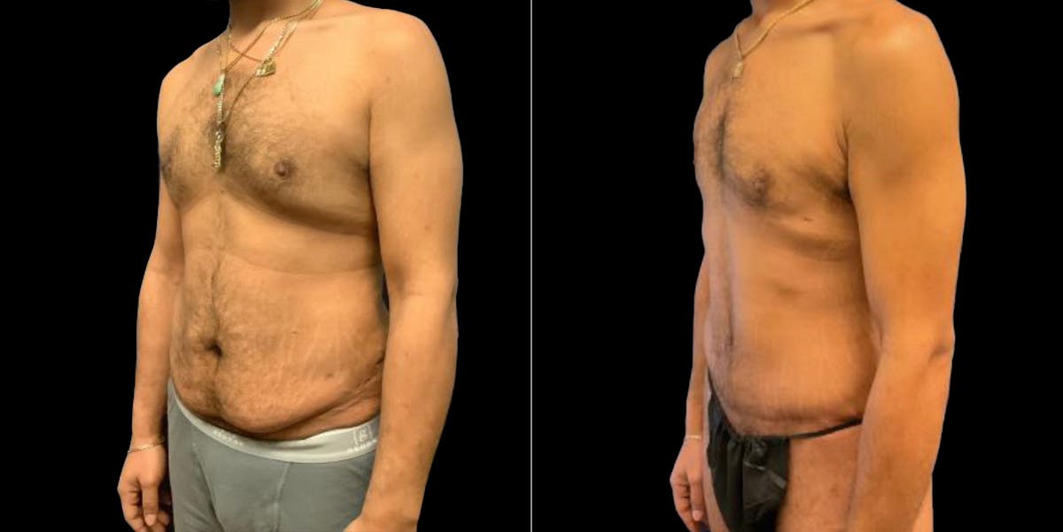 Abdominoplasty Before & After Gallery - Patient 809044 - Image 2